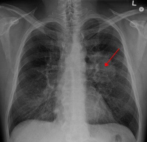 Doctor-patient discussions neglect potential harms of lung cancer screening, study finds